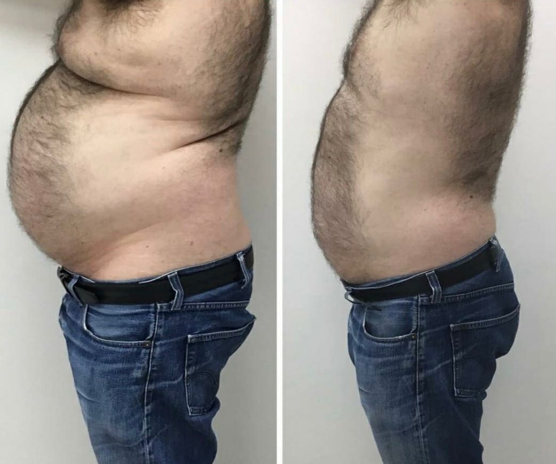 🔥 BURN EXTREME – El Mejor Suplemento Natural Para Adelgazar Rápido y Seguro